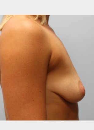 Before Image: Breast Augmentation With Mastopexy (Lift) – Dr. Tucker - other