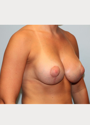After Image: Breast Augmentation With Mastopexy (Lift) – Dr. Tucker - other