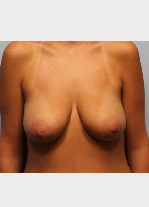Before Image: Breast Augmentation With Mastopexy (Lift) – Dr. Tucker - front