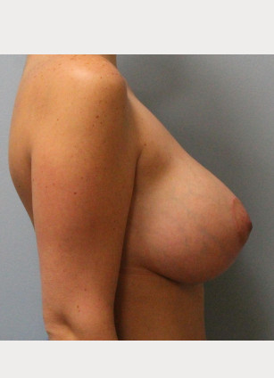 After Image: Breast Augmentation With Mastopexy (Lift) – Dr. Tucker - other
