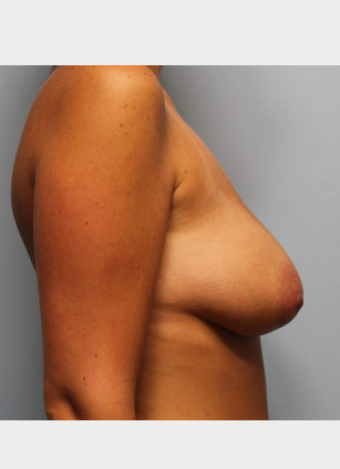 Before Image: Breast Augmentation With Mastopexy (Lift) – Dr. Tucker - other