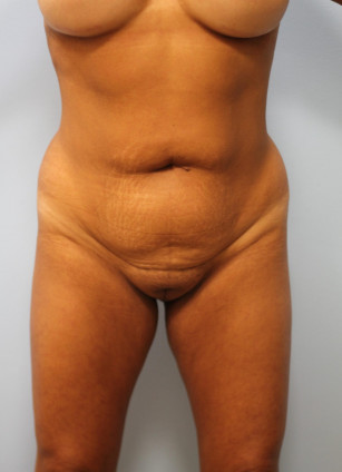 Before Image: Brazilian Butt Lift and Smart Lipo – Dr. Howell - front