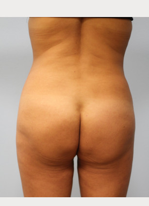 After Image: Brazilian Butt Lift and Smart Lipo – Dr. Howell - back