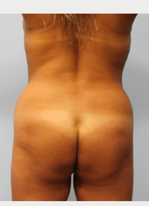 Before Image: Brazilian Butt Lift and Smart Lipo – Dr. Howell - back