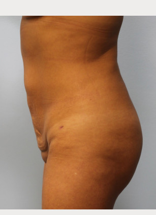 After Image: Brazilian Butt Lift and Smart Lipo – Dr. Howell - other