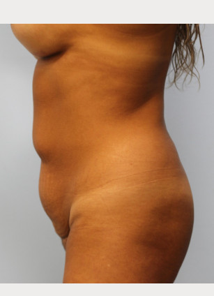 Before Image: Brazilian Butt Lift and Smart Lipo – Dr. Howell - other