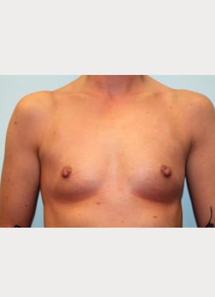 Breast Augmentation – Dr. Howell