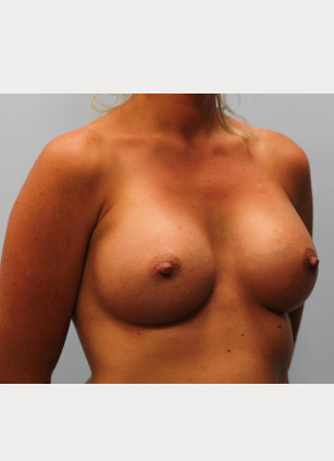 After Image: Breast Augmentation – Dr. Howell - other