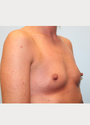 Before Image: Breast Augmentation – Dr. Howell - other