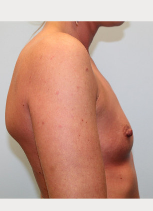 Before Image: Breast Augmentation – Dr. Howell - other