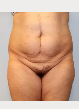 Before Image: Abdominoplasty (Tummy Tuck) – Dr. Howell - front