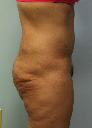 After Image: Abdominoplasty (Tummy Tuck) – Dr. Howell - other