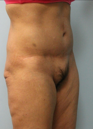 After Image: Abdominoplasty (Tummy Tuck) – Dr. Howell - other