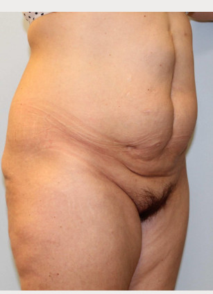 Before Image: Abdominoplasty (Tummy Tuck) – Dr. Howell - other
