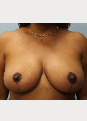 Breast Reduction – Dr. Howell