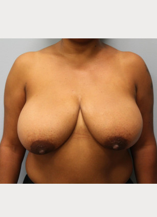 Before Image: Breast Reduction – Dr. Howell - front