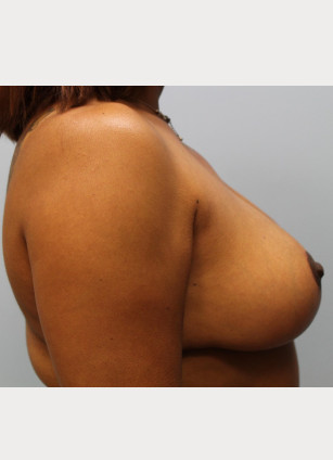 After Image: Breast Reduction – Dr. Howell - other