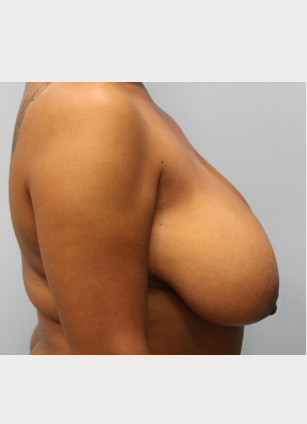 Before Image: Breast Reduction – Dr. Howell - other