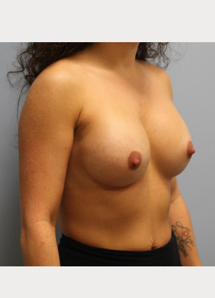After Image: Breast Augmentation Revision – Dr. Tucker - other