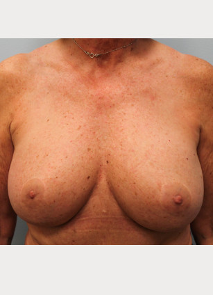After Image: Breast Augmentation – Dr. Tucker - front