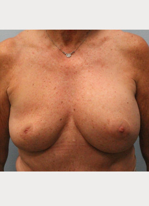 Before Image: Breast Augmentation – Dr. Tucker - front