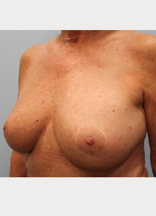 After Image: Breast Augmentation – Dr. Tucker - left-front-oblique