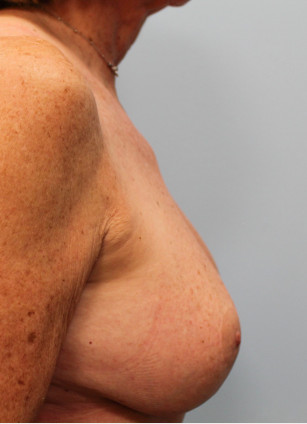 After Image: Breast Augmentation – Dr. Tucker - right-side