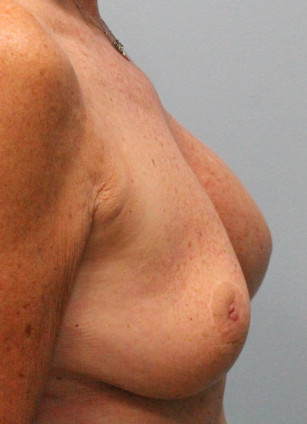 Before Image: Breast Augmentation – Dr. Tucker - right-side