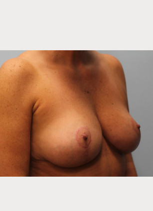 After Image: Breast Reduction – Dr. Howell - other