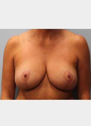 After Image: Breast Reduction – Dr. Howell - front