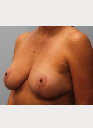 After Image: Breast Reduction – Dr. Howell - other