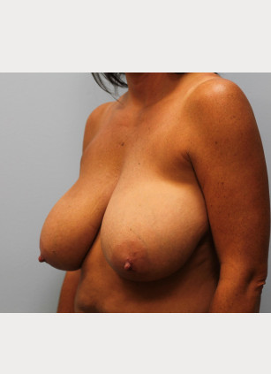 Before Image: Breast Reduction – Dr. Howell - other