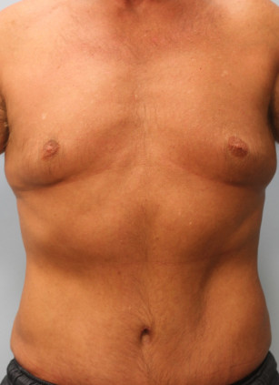 Male Abdominoplasty (Tummy Tuck) – Dr. Howell