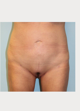 After Image: Liposuction of Abdomen, Hips, and Thighs- Dr.Howell - front