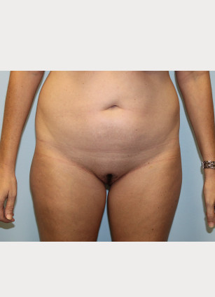 Before Image: Liposuction of Abdomen, Hips, and Thighs- Dr.Howell - front