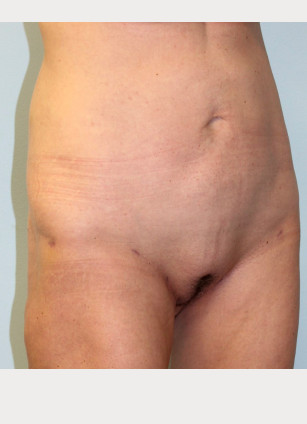 After Image: Liposuction of Abdomen, Hips, and Thighs- Dr.Howell - right-front-oblique