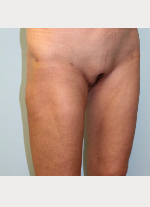 After Image: Liposuction of Abdomen, Hips, and Thighs- Dr.Howell - right-front-oblique