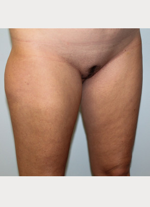 Before Image: Liposuction of Abdomen, Hips, and Thighs- Dr.Howell - right-front-oblique