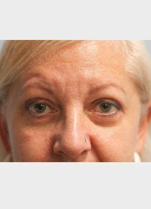 After Image: Upper and Lower Blepharoplasty-Dr.Howell - front