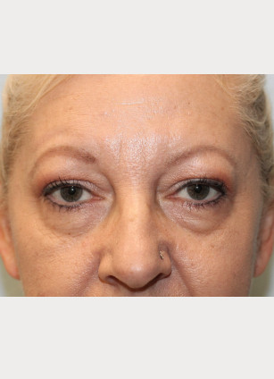 Before Image: Upper and Lower Blepharoplasty-Dr.Howell - front
