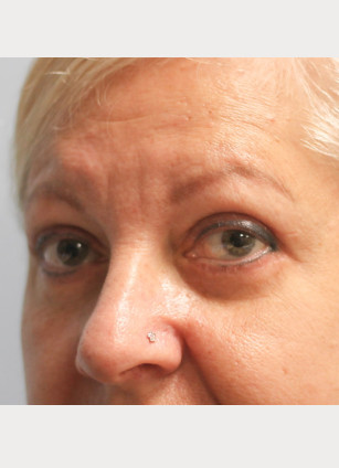 After Image: Upper and Lower Blepharoplasty-Dr.Howell - left-front-oblique