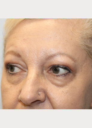 Before Image: Upper and Lower Blepharoplasty-Dr.Howell - left-front-oblique