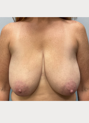 Before Image: Breast Reduction- Dr.Howell - front