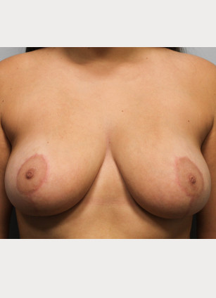 After Image: Breast Reduction and Lift-Dr.Howell - front