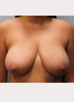 Before Image: Breast Reduction and Lift-Dr.Howell - front