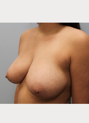 Before Image: Breast Reduction and Lift-Dr.Howell - left-front-oblique