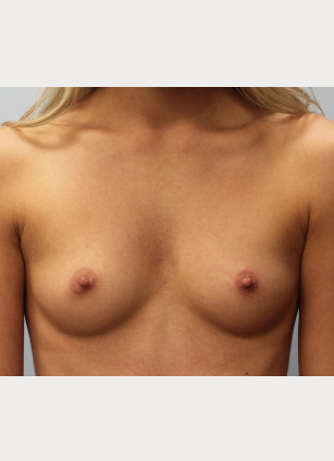 Before Image: Breast Augmentation- Dr. Howell - front