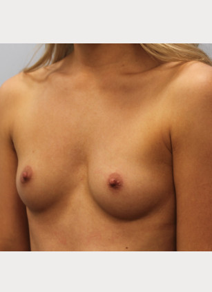 Before Image: Breast Augmentation- Dr. Howell - left-front-oblique
