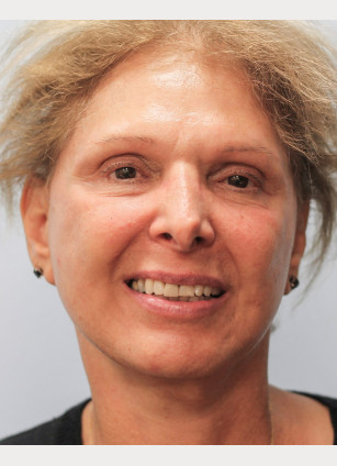 After Image: Facelift and Neck Lipo-Dr.Howell - front