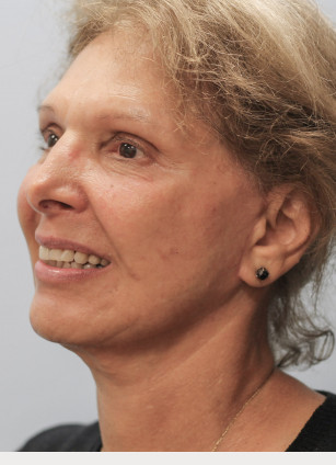 After Image: Facelift and Neck Lipo-Dr.Howell - left-front-oblique